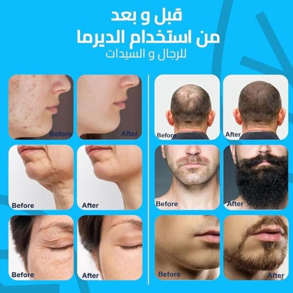 ديرما رولر ستامب قلم